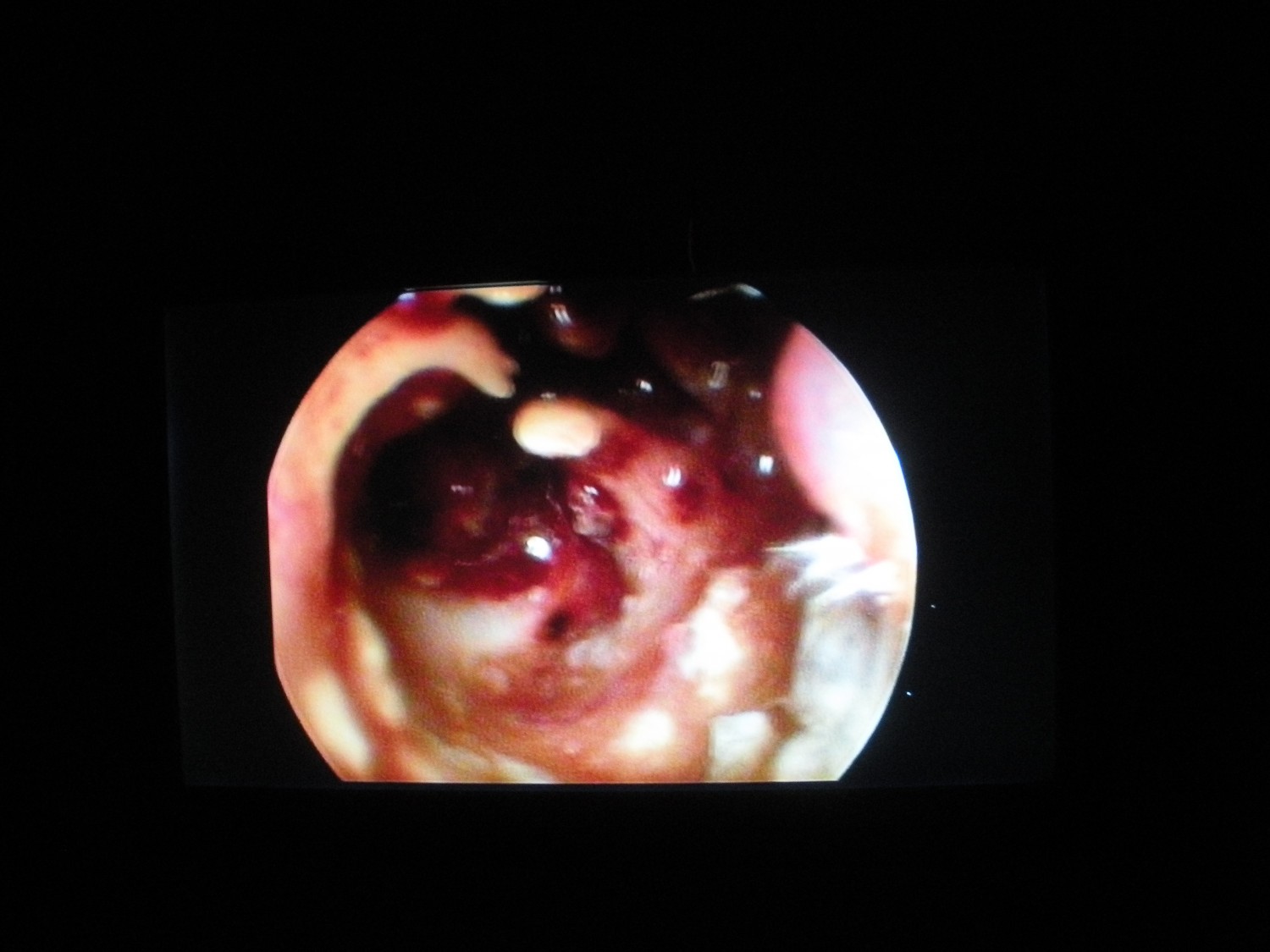 Video Otoscopy